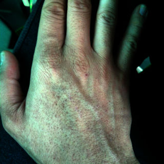 Mano llena de petequias.